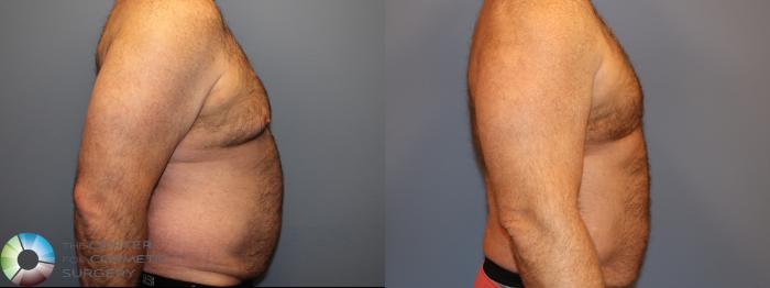 Before & After Male Breast Reduction (Gynecomastia) Case 12012 Right Side in Denver and Colorado Springs, CO