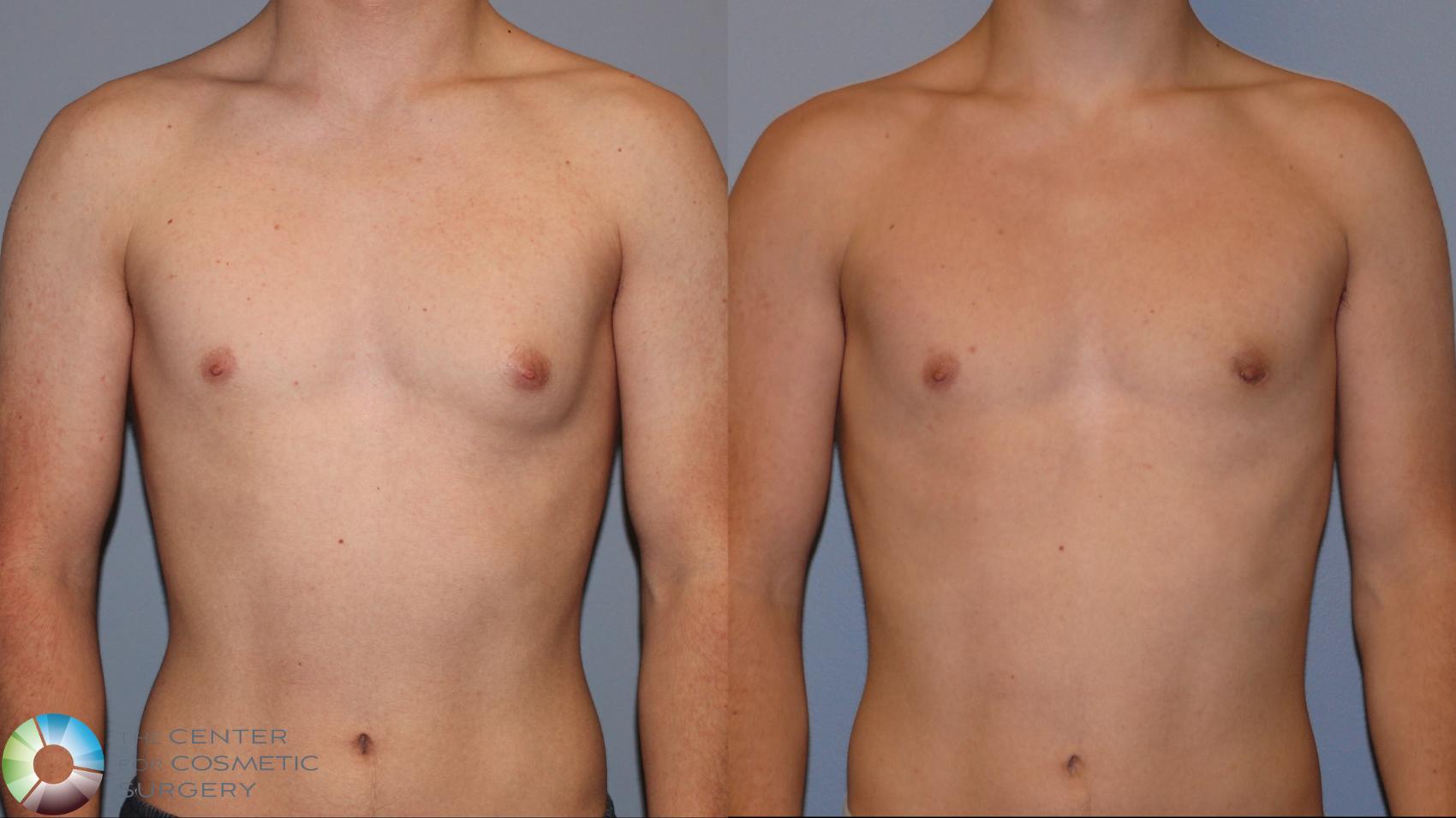 Before & After Male Breast Reduction (Gynecomastia) Case 12108 Front in Denver and Colorado Springs, CO