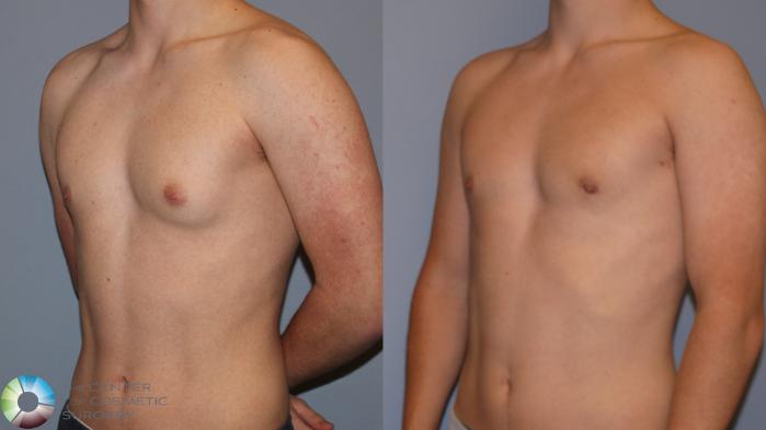 Before & After Male Breast Reduction (Gynecomastia) Case 12108 Left Oblique in Denver and Colorado Springs, CO