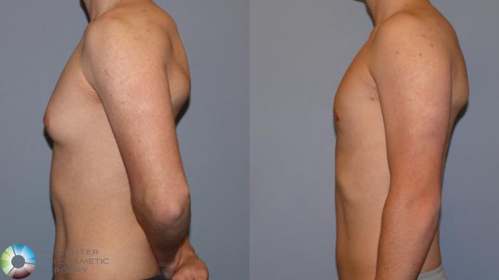 Before & After Male Breast Reduction (Gynecomastia) Case 12108 Left Side in Denver and Colorado Springs, CO