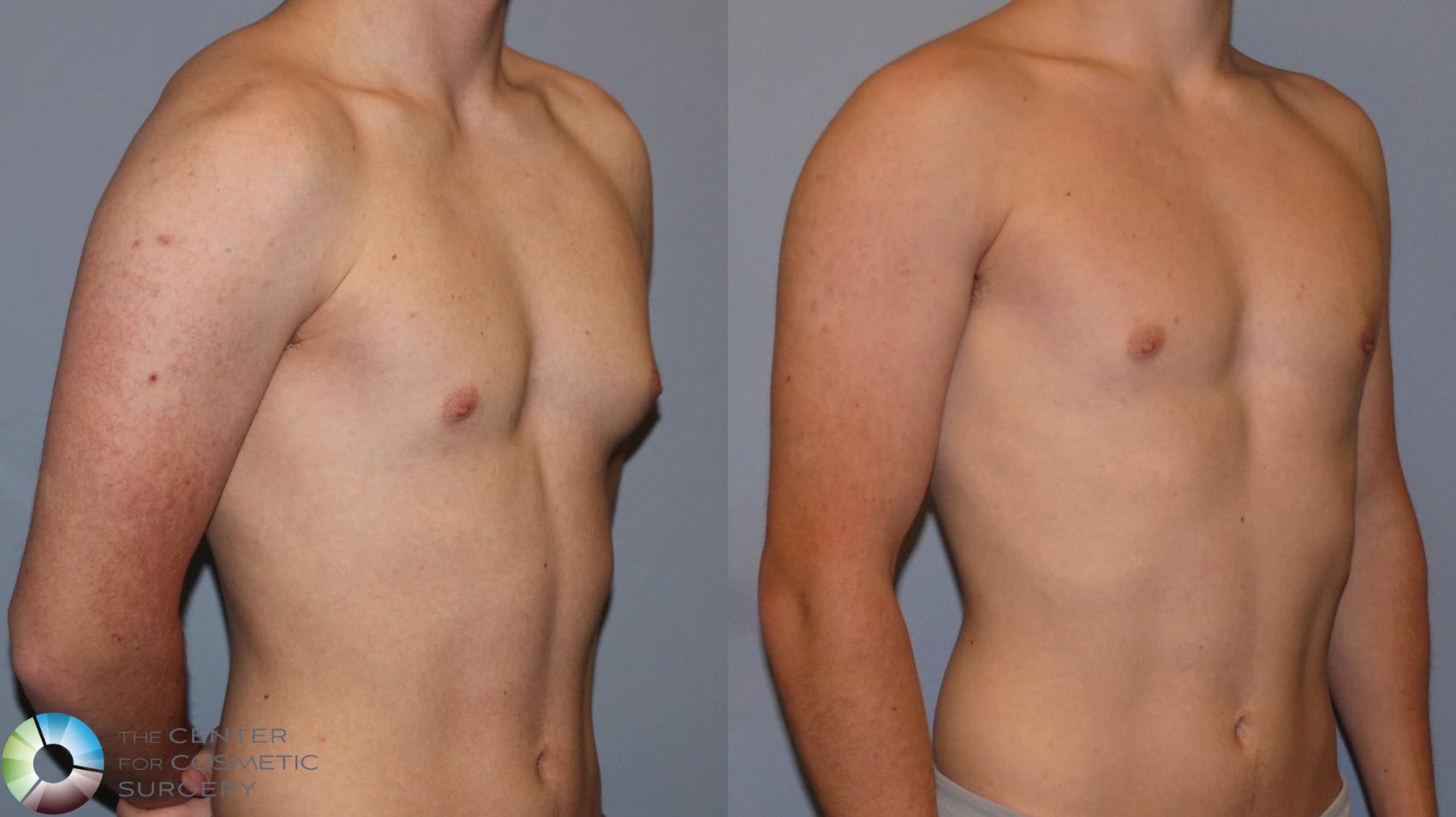 Before & After Male Breast Reduction (Gynecomastia) Case 12108 Right Oblique in Denver and Colorado Springs, CO