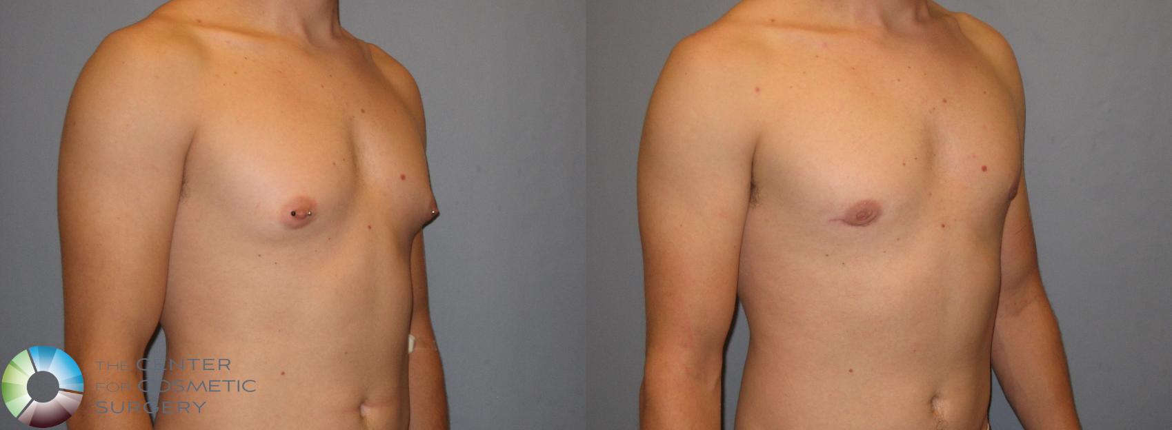 Before & After Male Breast Reduction (Gynecomastia) Case 258 View #1 in Denver, CO