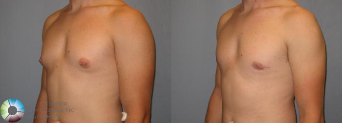 Before & After Male Breast Reduction (Gynecomastia) Case 258 View #2 View in Golden, CO