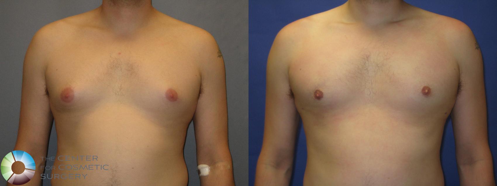 Before & After Male Breast Reduction (Gynecomastia) Case 288 View #1 View in Denver & Golden, CO