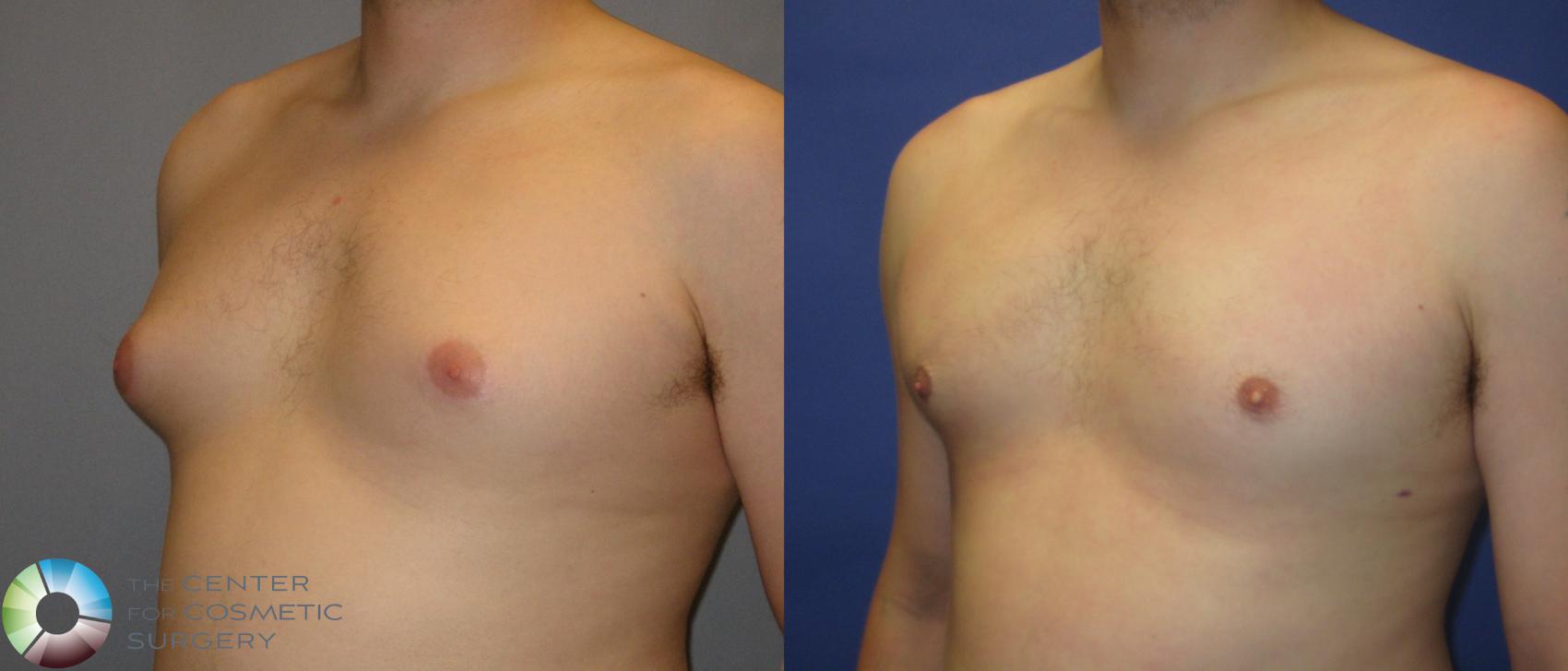 Before & After Male Breast Reduction (Gynecomastia) Case 288 View #2 View in Denver & Golden, CO
