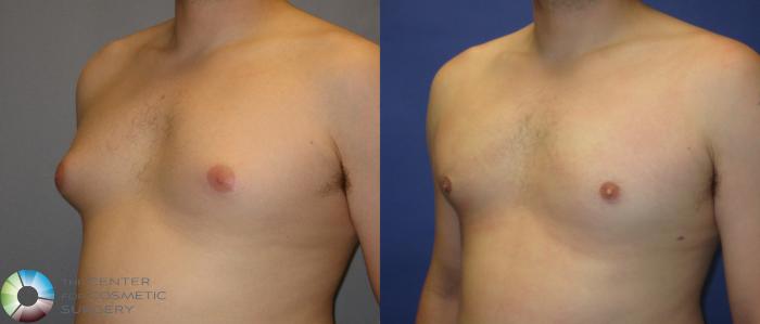 Before & After Liposuction Case 288 View #2 View in Golden, CO