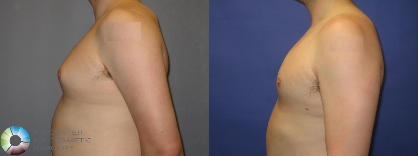 Before & After Male Breast Reduction (Gynecomastia) Case 288 View #3 View in Denver & Golden, CO