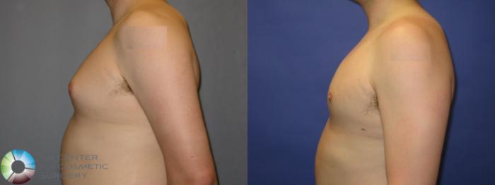 Before & After Male Breast Reduction (Gynecomastia) Case 288 View #3 View in Golden, CO