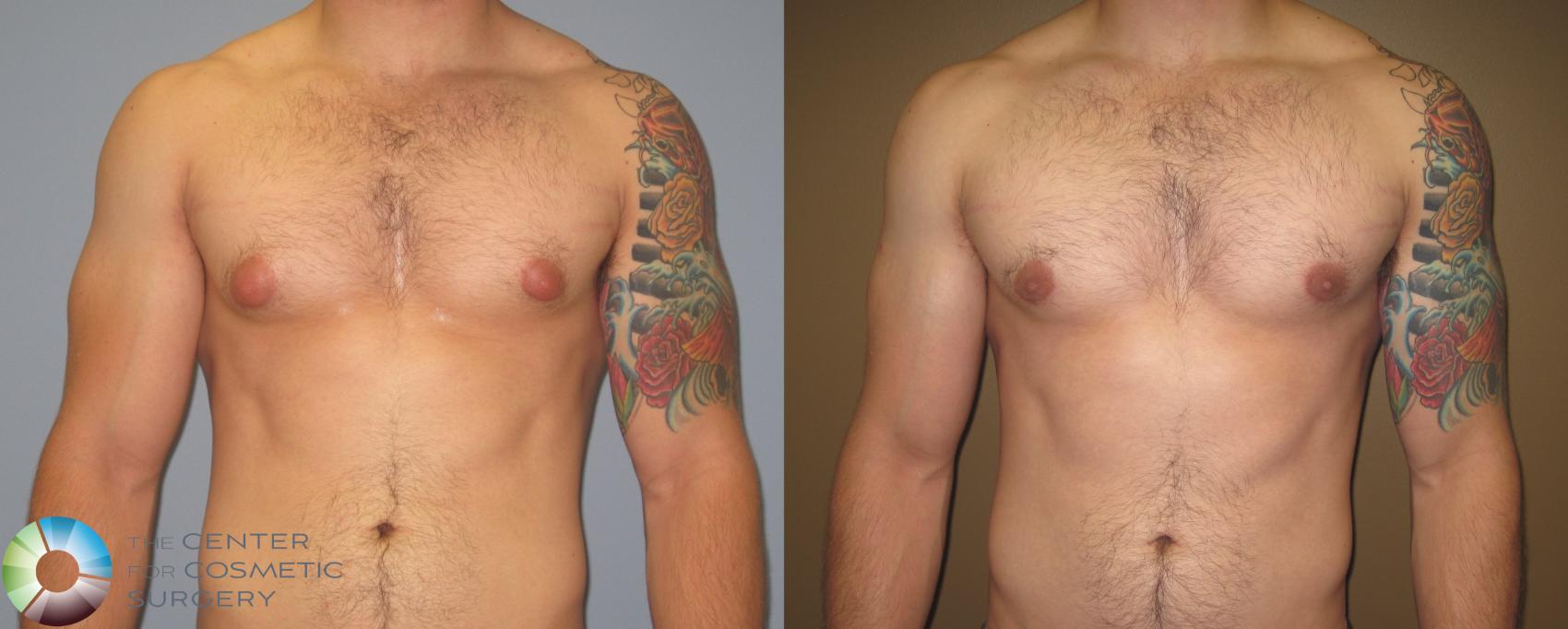 Before & After Male Breast Reduction (Gynecomastia) Case 451 View #2 View in Denver & Golden, CO