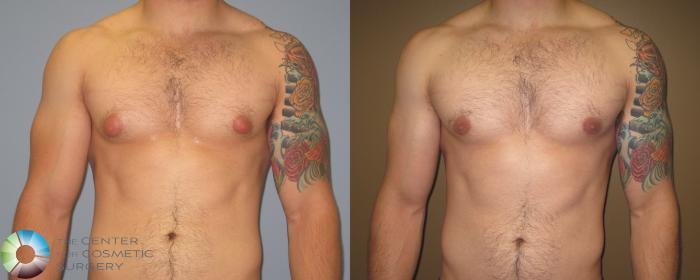 Before & After Male Breast Reduction (Gynecomastia) Case 451 View #2 View in Golden, CO