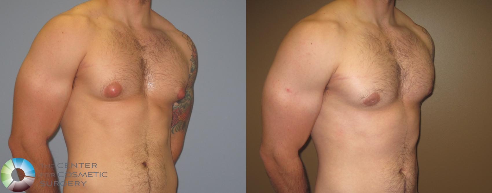 Before & After Male Breast Reduction (Gynecomastia) Case 451 View #3 View in Denver & Golden, CO