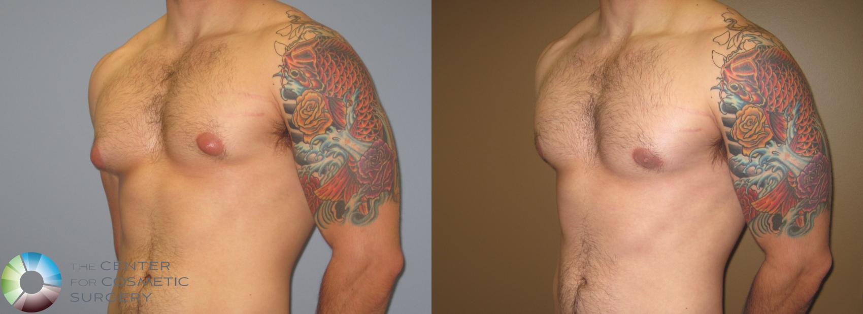 Before & After Male Breast Reduction (Gynecomastia) Case 451 View #4 View in Denver & Golden, CO