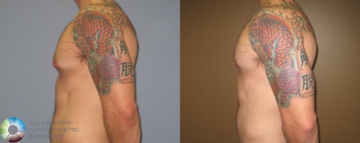 Before & After Male Breast Reduction (Gynecomastia) Case 451 View #5 View in Golden, CO