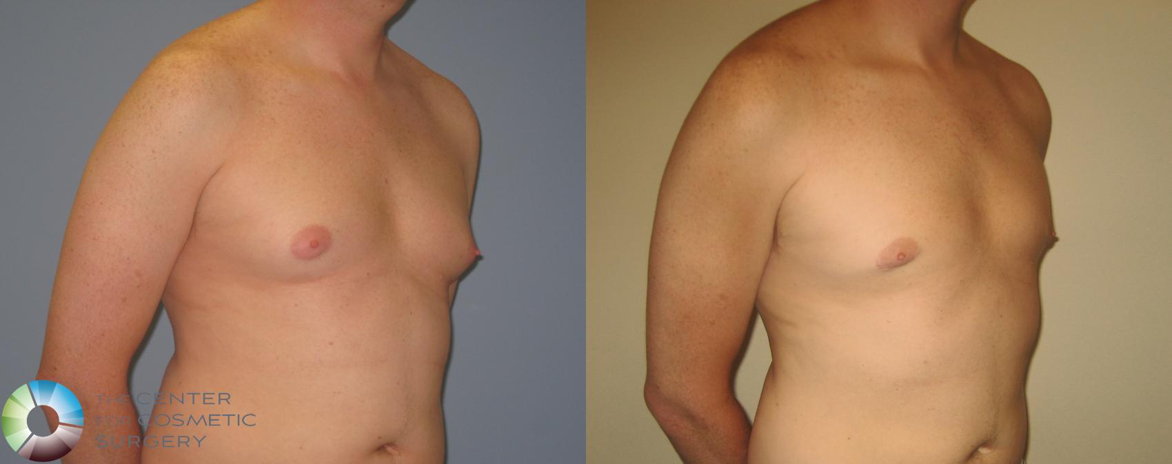 Male Breast Reduction (Gynecomastia) Before and After Pictures Case 452, Denver, CO