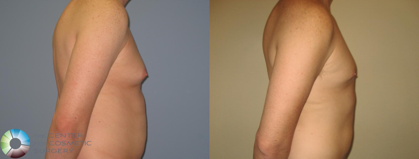 Before & After Male Breast Reduction (Gynecomastia) Case 452 View #2 View in Denver & Golden, CO
