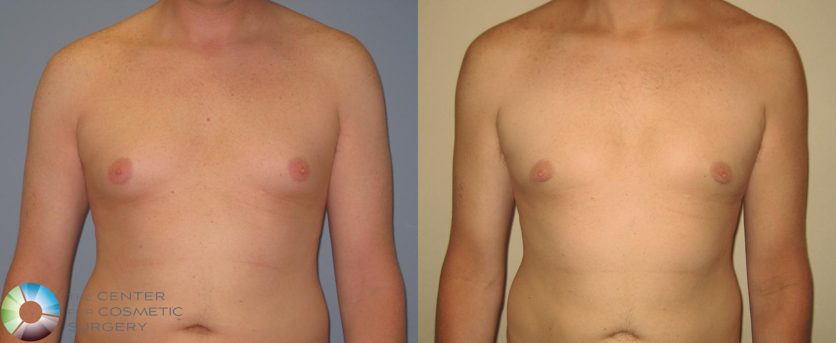Before & After Male Breast Reduction (Gynecomastia) Case 452 View #3 View in Denver & Golden, CO