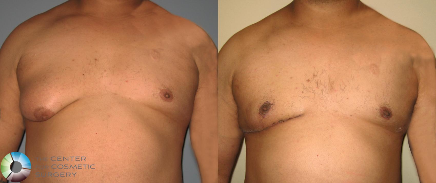 Before & After Male Breast Reduction (Gynecomastia) Case 456 View #1 in Denver, CO