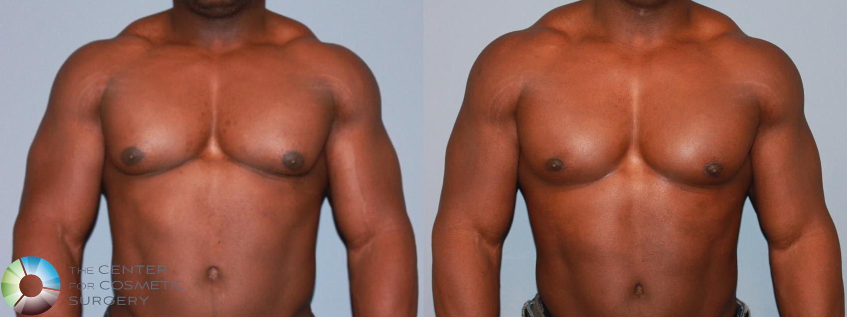 Male Breast Reduction (Gynecomastia Surgery) Denver & Colorado