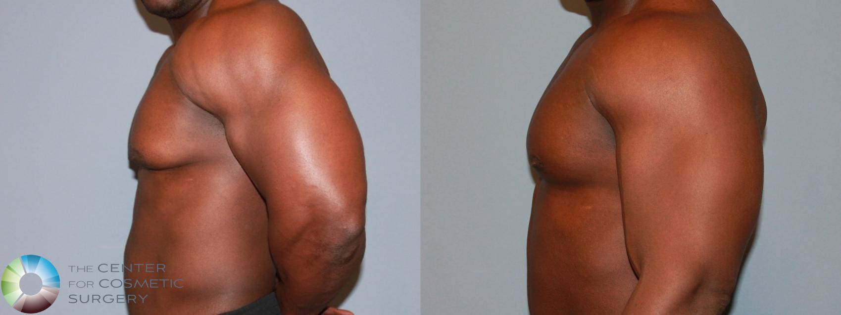 Before & After Male Breast Reduction (Gynecomastia) Case 477 View #3 View in Denver & Golden, CO