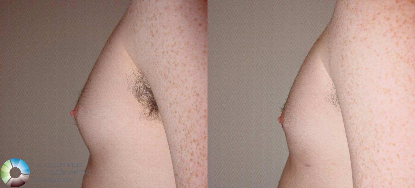 Before & After Male Breast Reduction (Gynecomastia) Case 499 View #2 in Denver and Colorado Springs, CO