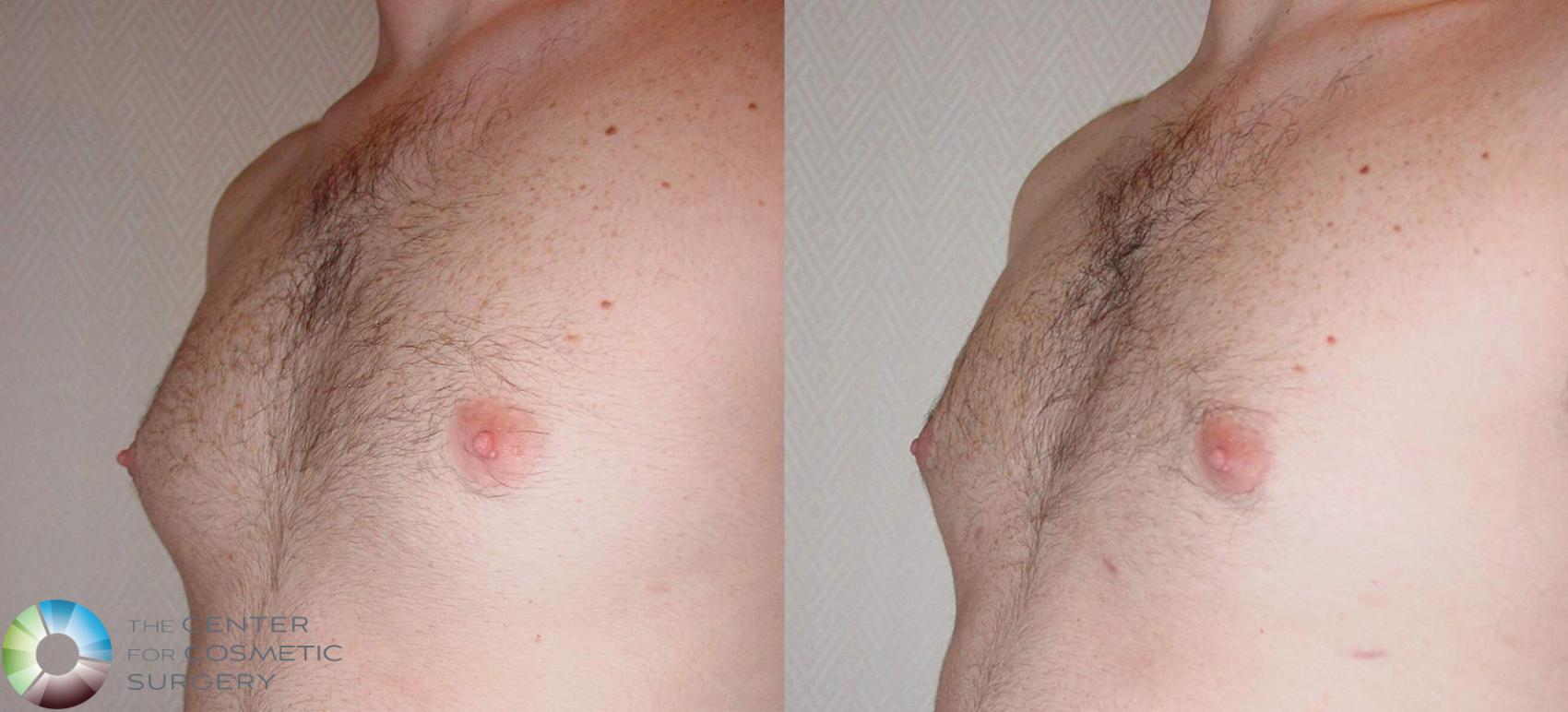 Before & After Male Breast Reduction (Gynecomastia) Case 499 View #3 in Denver and Colorado Springs, CO