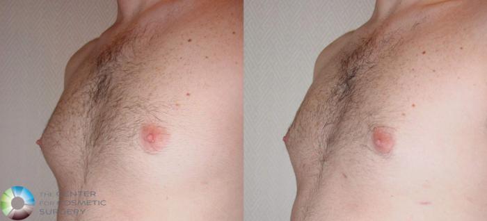 Before & After Male Breast Reduction (Gynecomastia) Case 499 View #3 View in Golden, CO