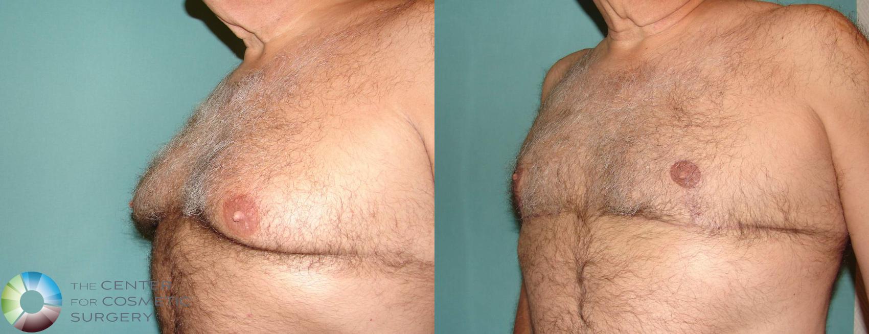 Before & After Male Breast Reduction (Gynecomastia) Case 635 View #2 View in Denver & Golden, CO