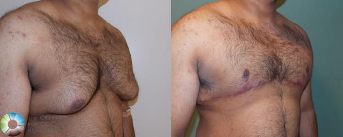 Before & After Male Breast Reduction (Gynecomastia) Case 711 View #2 View in Golden, CO