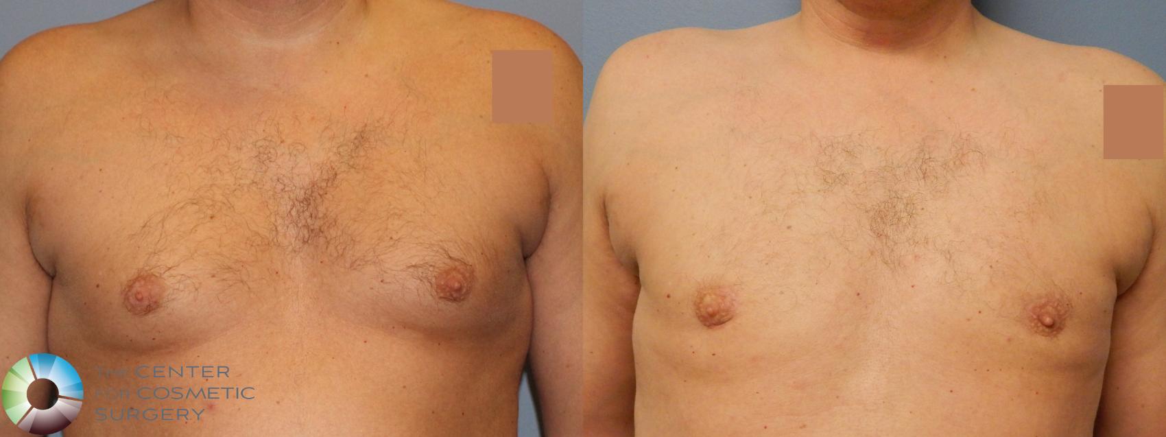 Before & After Male Breast Reduction (Gynecomastia) Case 896 Anterior in Denver and Colorado Springs, CO