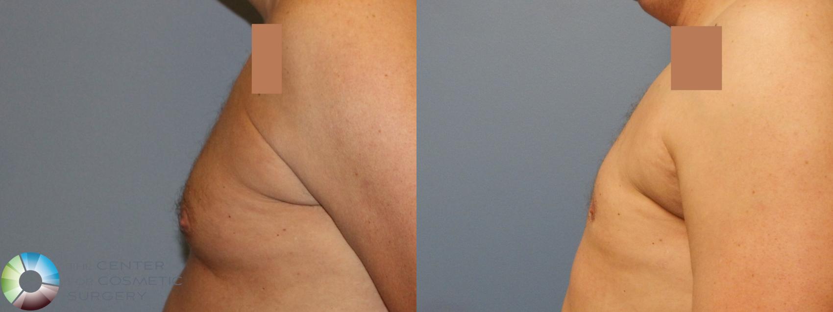 Before & After Male Breast Reduction (Gynecomastia) Case 896 Left Lateral in Denver and Colorado Springs, CO