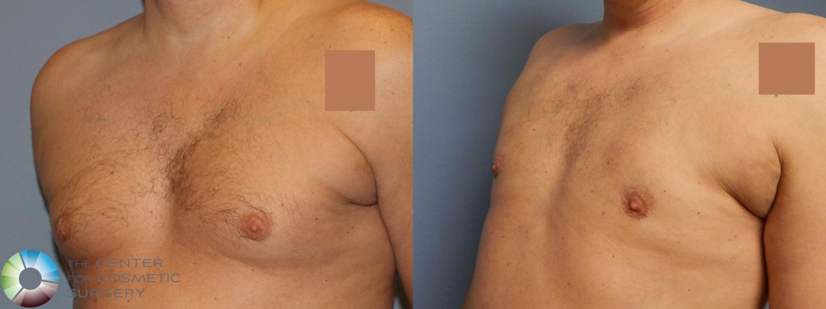 Before & After Male Breast Reduction (Gynecomastia) Case 896 Left Oblique in Denver and Colorado Springs, CO