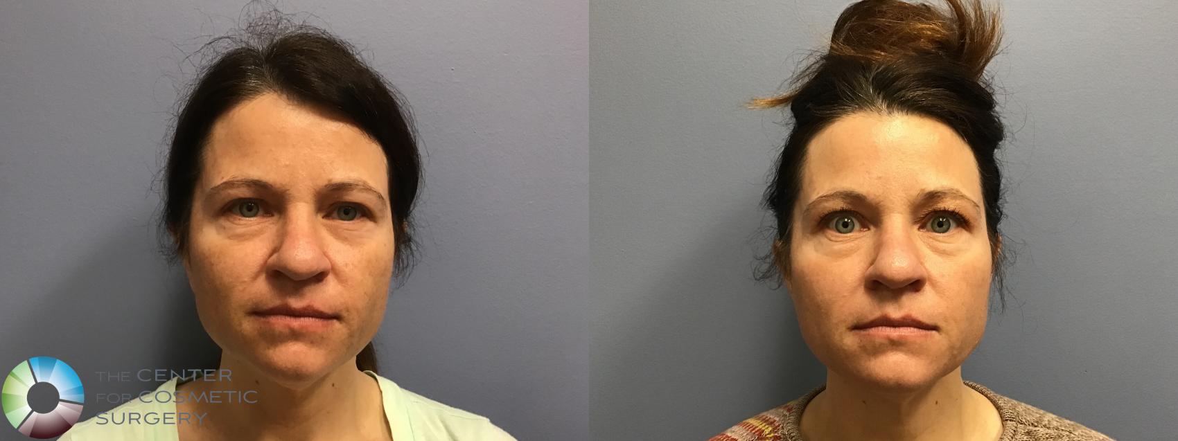 Before & After Microneedling Case 11578 Front View in Denver & Golden, CO