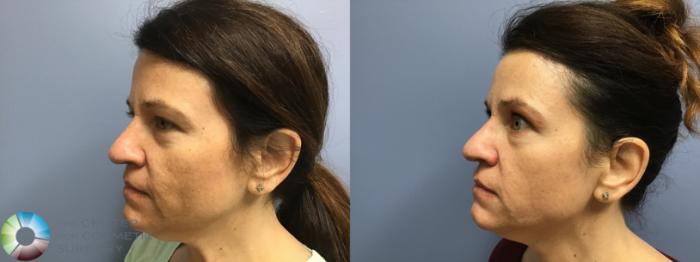 Before & After Microneedling Case 11578 Left Oblique View in Golden, CO