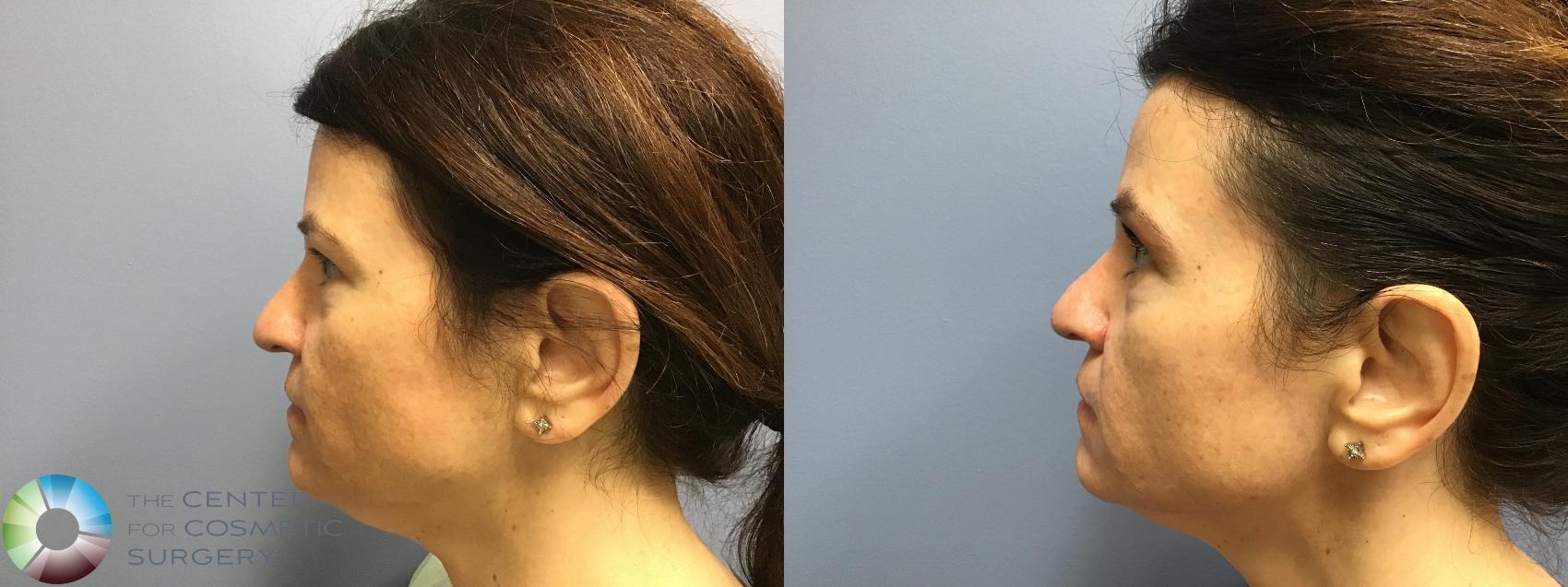 Before & After Microneedling Case 11578 Left Side View in Golden, CO