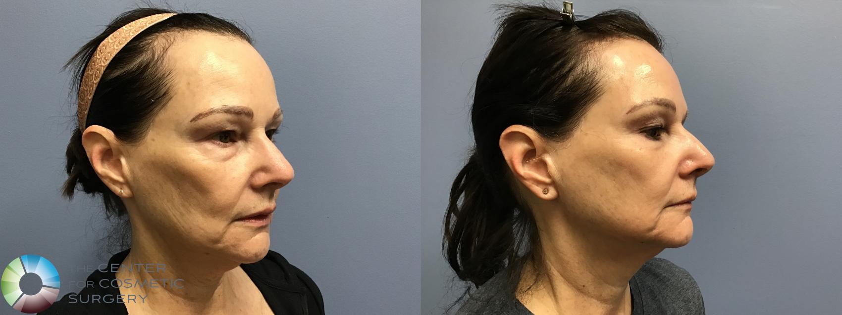 Before & After Genius® RF Microneedling Case 11579 Right Oblique in Denver and Colorado Springs, CO