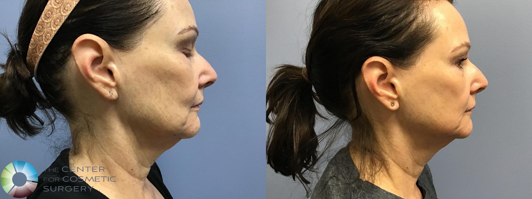Before & After Genius® RF Microneedling Case 11579 Right Side in Denver and Colorado Springs, CO
