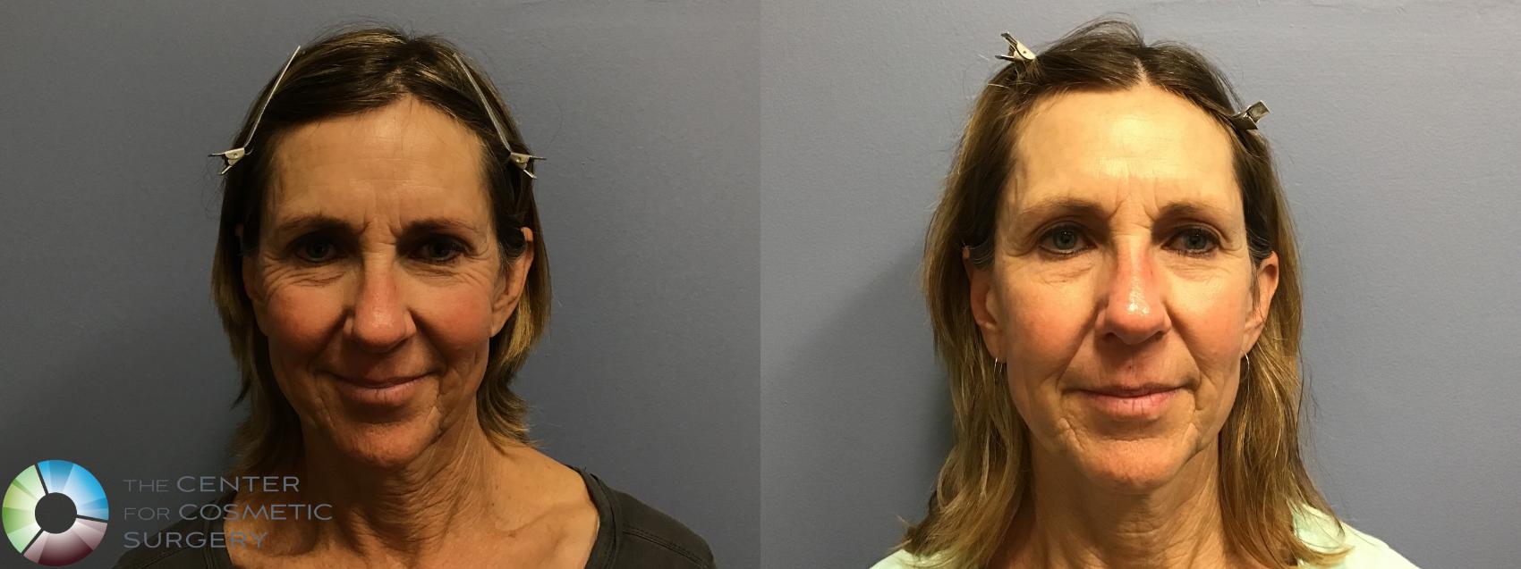 Before & After Genius® RF Microneedling Case 11580 Front in Denver and Colorado Springs, CO