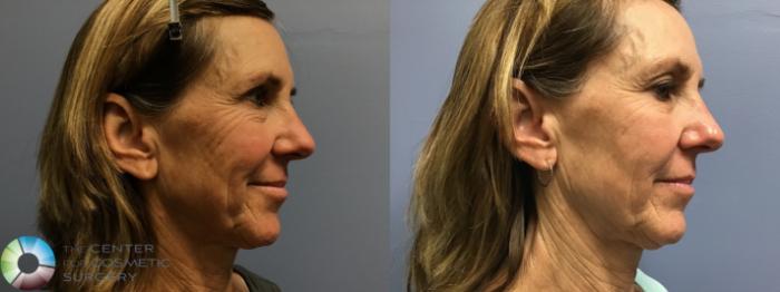 Before & After Microneedling Case 11580 Right Oblique View in Golden, CO