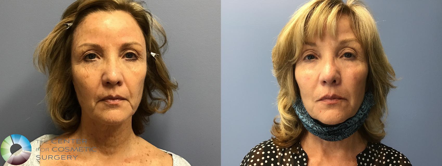 Before & After Microneedling Case 11586 Front View in Golden, CO