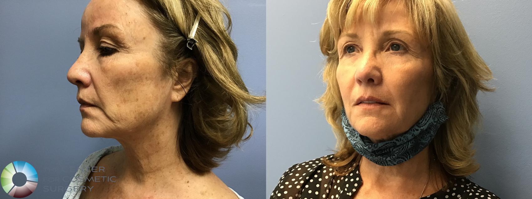 Before & After Genius® RF Microneedling Case 11586 Left Oblique in Denver and Colorado Springs, CO