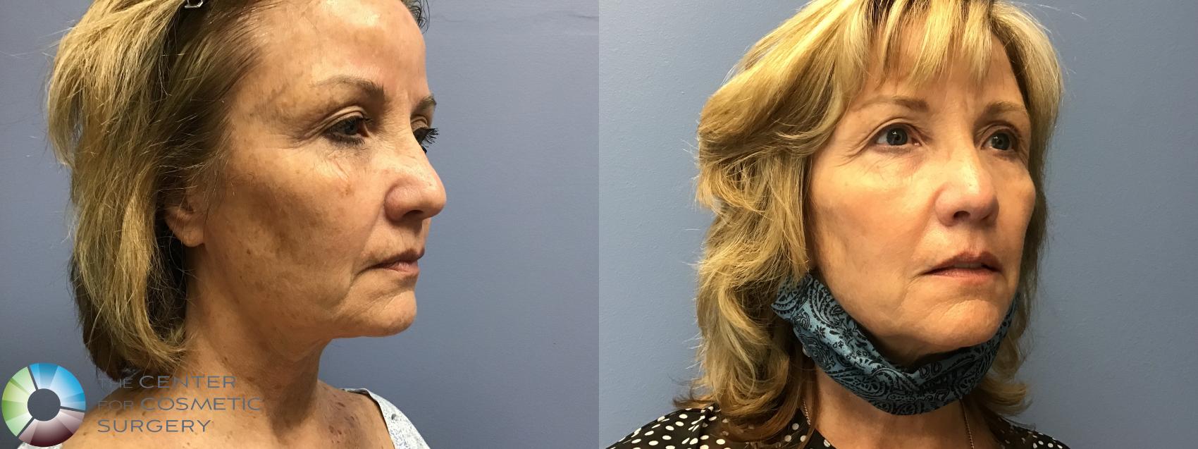 Before & After Genius® RF Microneedling Case 11586 Right Oblique in Denver and Colorado Springs, CO