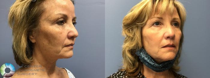 Before & After Microneedling Case 11586 Right Oblique View in Golden, CO