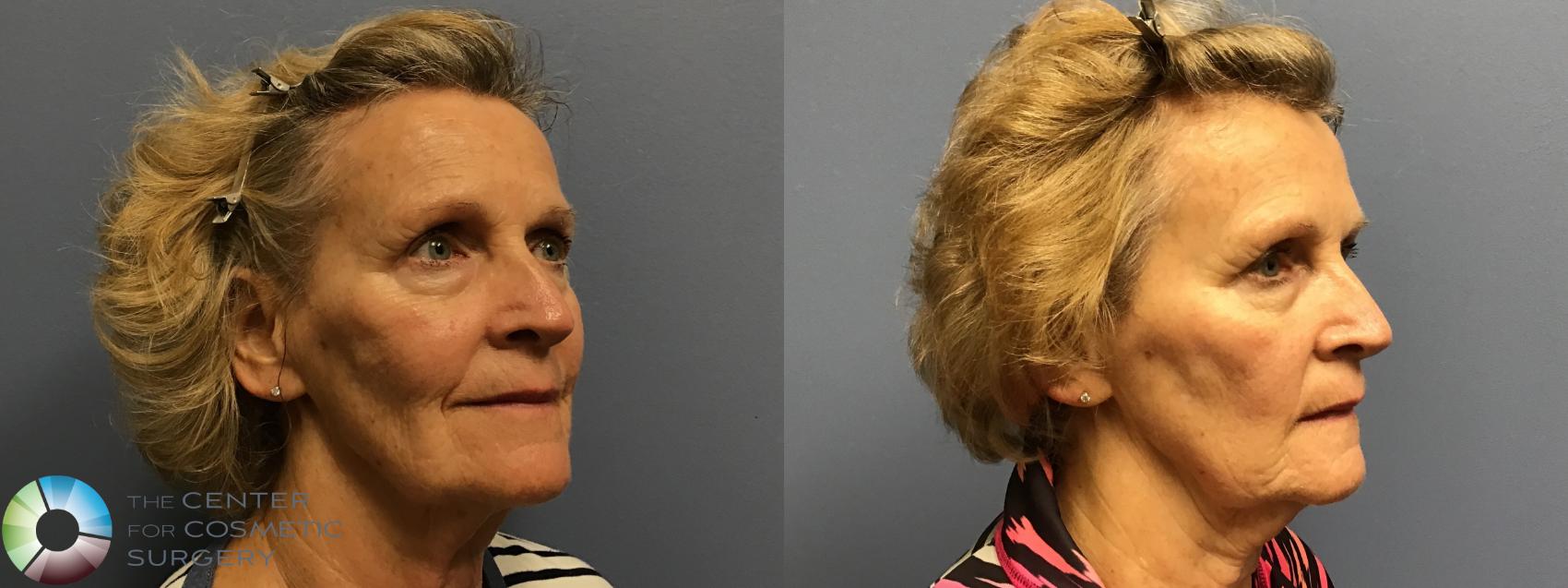 Before & After Genius® RF Microneedling Case 11599 Left Oblique in Denver and Colorado Springs, CO