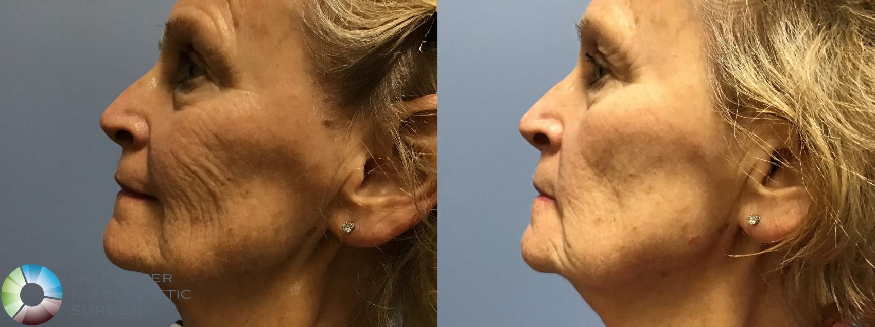 Before & After Genius® RF Microneedling Case 11599 Right Side in Denver and Colorado Springs, CO
