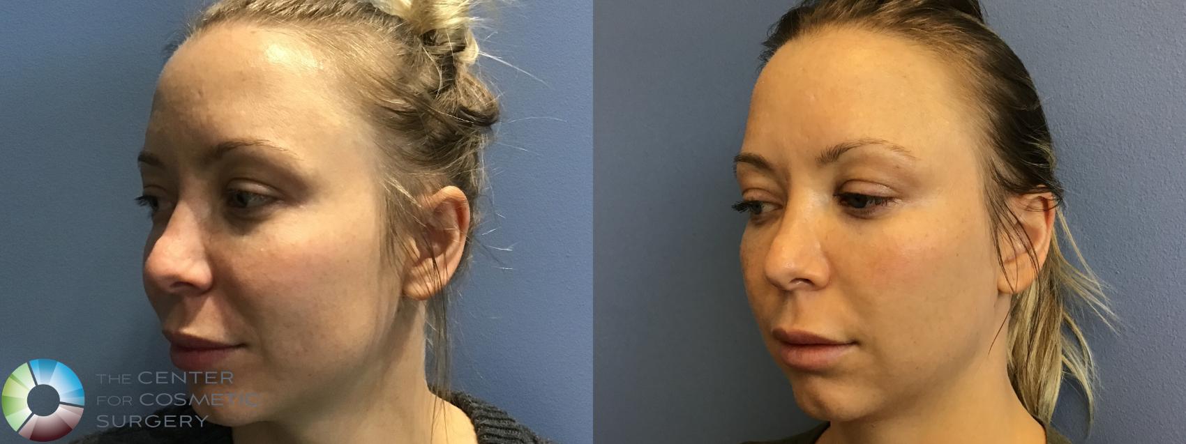 Before & After Genius® RF Microneedling Case 11600 Left Oblique in Denver and Colorado Springs, CO