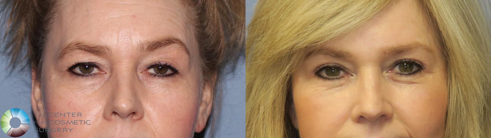 Before & After Eyelid Lift Case 11299 Front View in Golden, CO