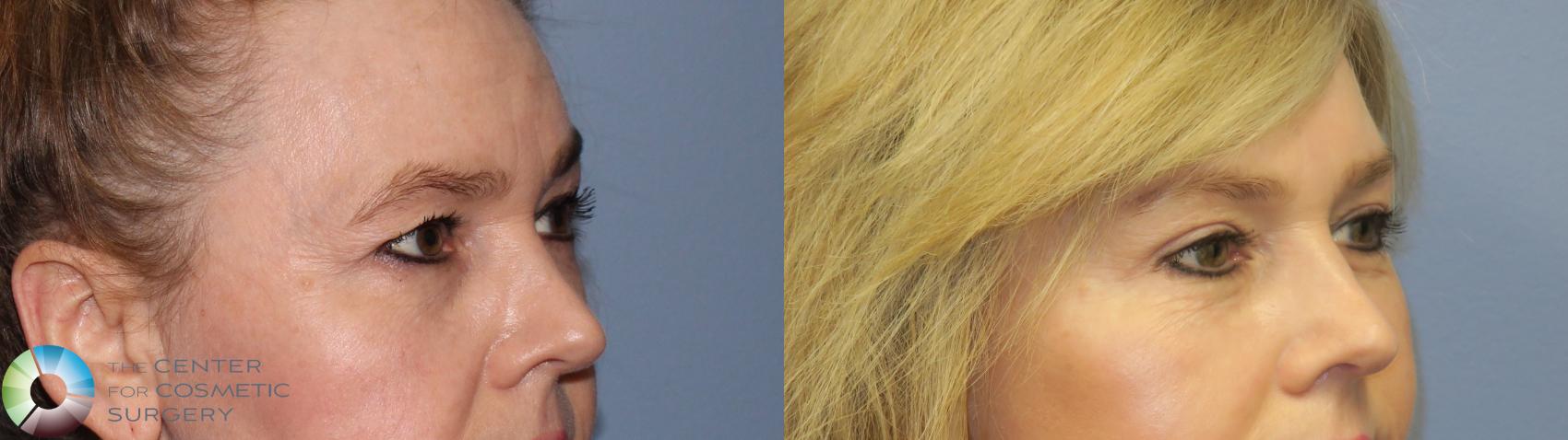Before & After Eyelid Lift Case 11299 Right Oblique View in Denver & Golden, CO
