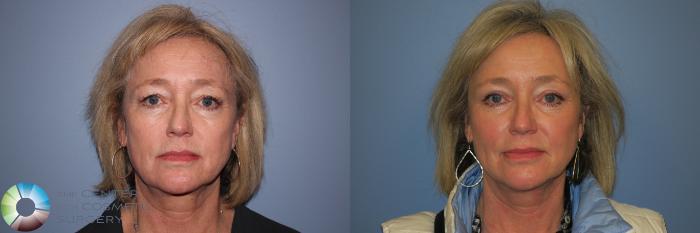Before & After Eyelid Lift Case 11458 Full Face View in Golden, CO