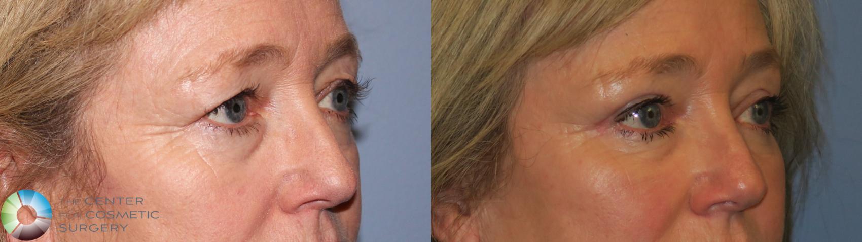 Before & After Mini Brow Lift Case 11458 Right Oblique View in Denver & Golden, CO