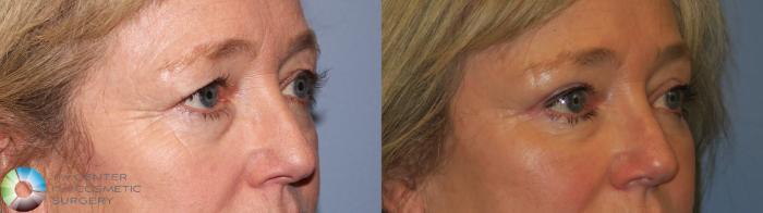 Before & After Mini Brow Lift Case 11458 Right Oblique View in Golden, CO
